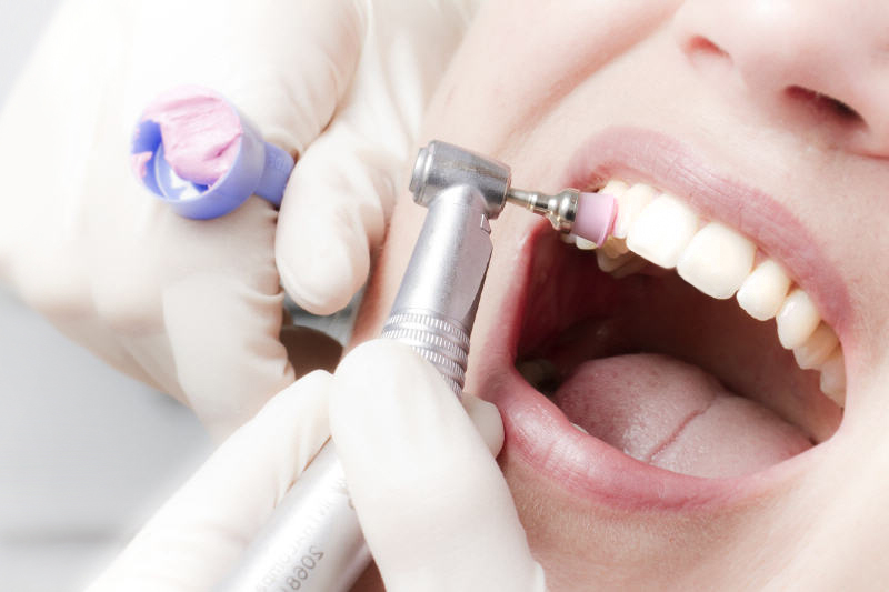Ультразвуковая чистка зубов + фторирование